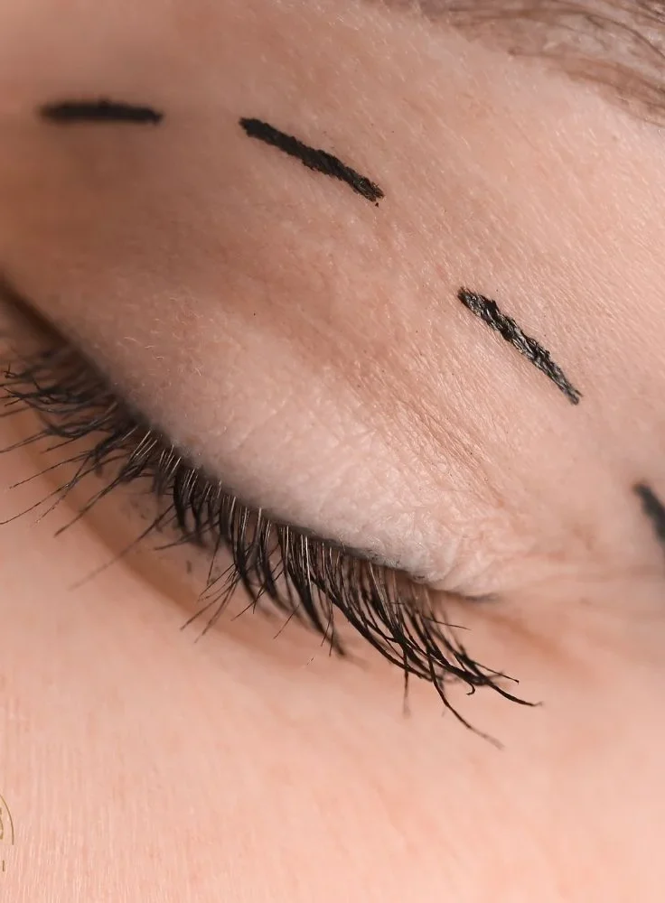 Göz Kapağı Estetiği Nedir