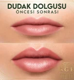 Dudak dolgusu öncesi ve sonrası