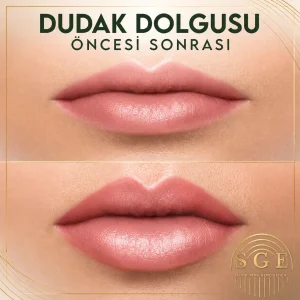 Dudak dolgusu öncesi ve sonrası