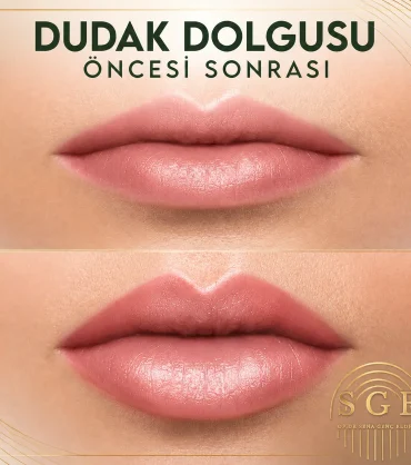 Dudak dolgusu öncesi ve sonrası